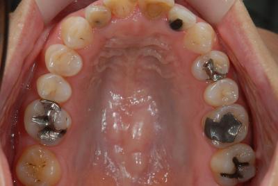 審美歯科　症例