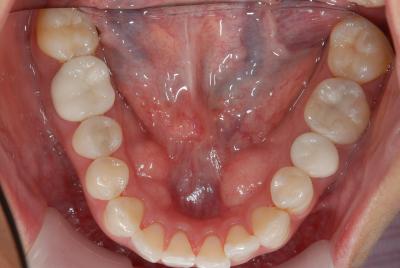 審美歯科　症例