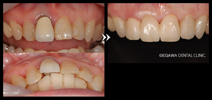 前歯の審美歯科オールセラミックブリッジ