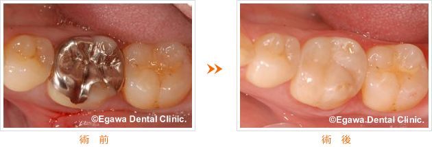 奥歯のダイレクトボンディングの症例
