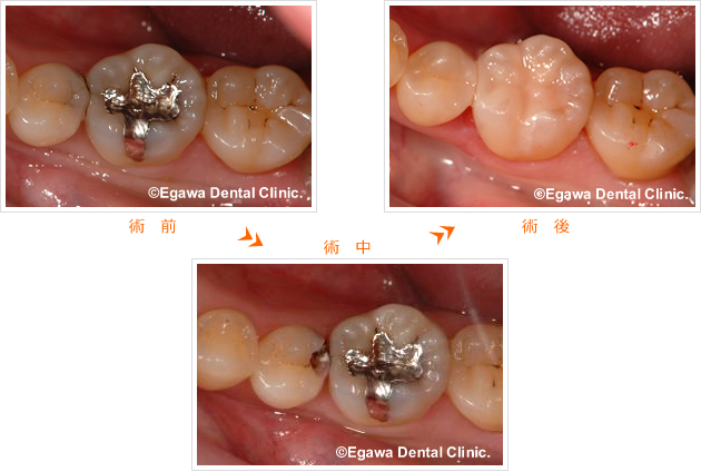 奥歯の銀歯と虫歯を白く 福岡県城南区の審美歯科