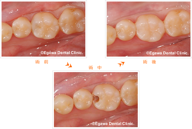 奥歯の虫歯をダイレクトボンディング 福岡県城南区の審美歯科