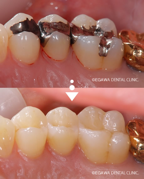 複数の銀歯をダイレクトボンディング