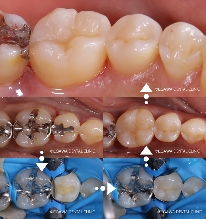 歯の間の銀歯を取って複雑なダイレクトボンディング