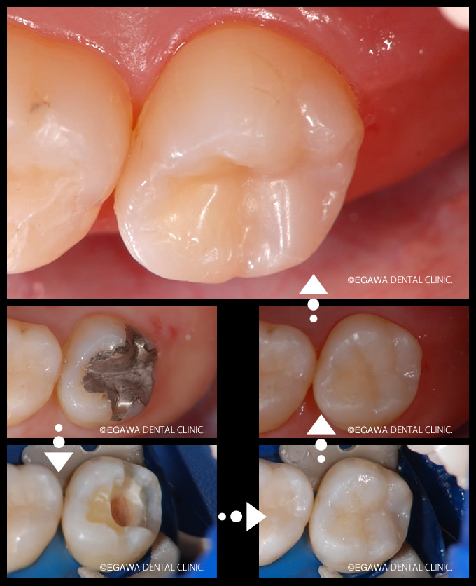 難しい奥歯の場所へダイレクトボンディング
