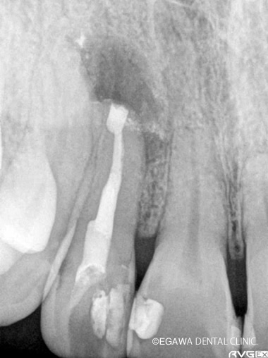 歯根端切除術中