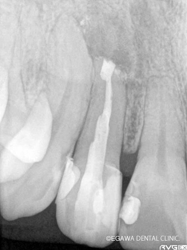 歯根端切除術後