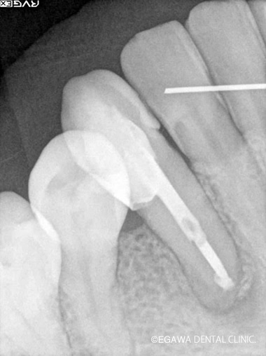 歯根端切除術後