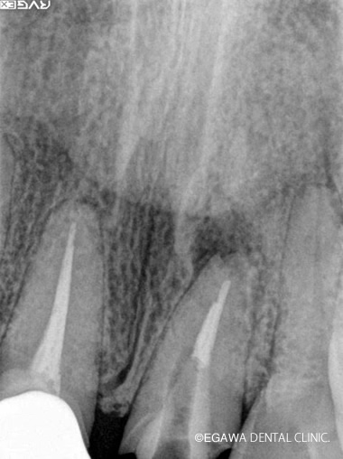 歯根端切除術中