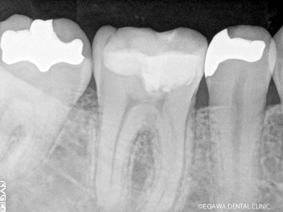 直接覆髄術後：レントゲン