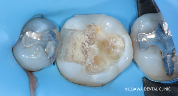 深い虫歯 マイクロスコープ精密根管治療 MTAセメント 歯内療法 | 福岡