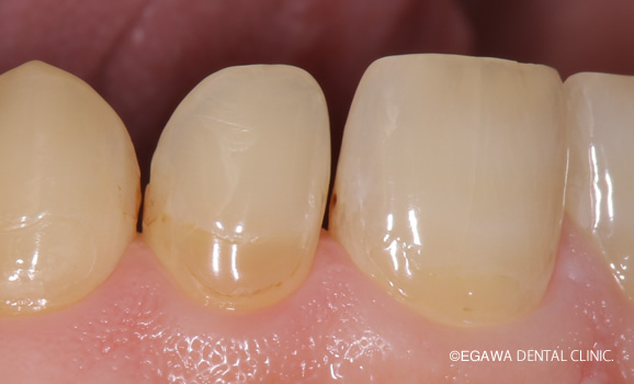 前歯の初期虫歯