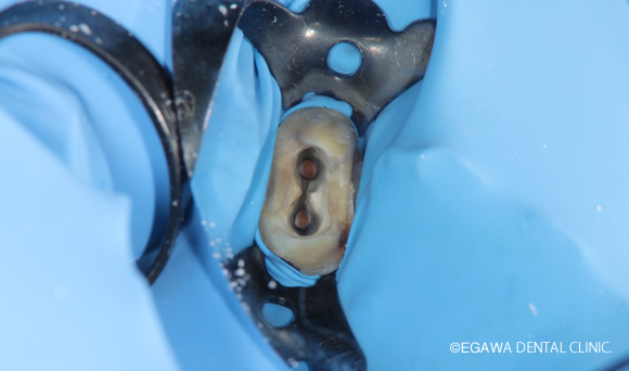 ラバーダム防湿