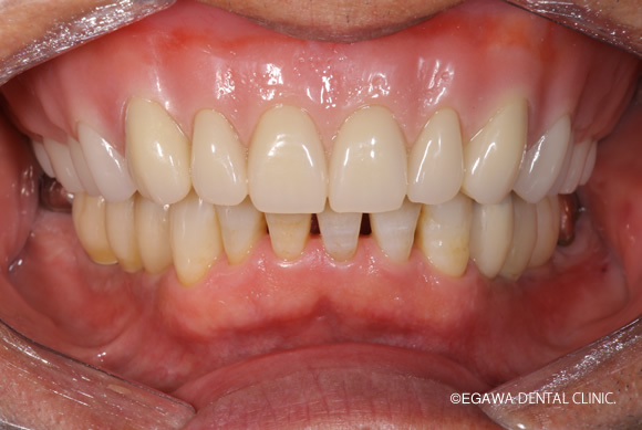 術後の金属床義歯正面