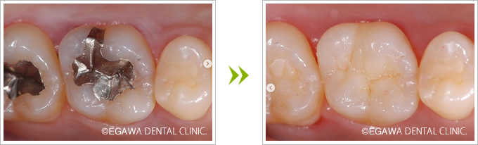 奥歯のダイレクトボンディング症例