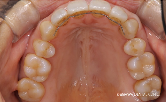 術後上顎：歯肉再生ラミネートべニア