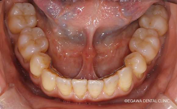 術後下顎：歯肉再生ラミネートべニア