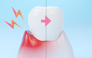 歯周病・歯肉炎の改善