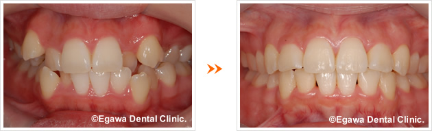八重歯の矯正歯科の症例