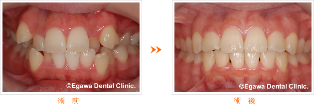 八重歯の症例