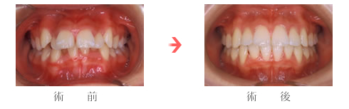上顎前突（出っ歯）の症例