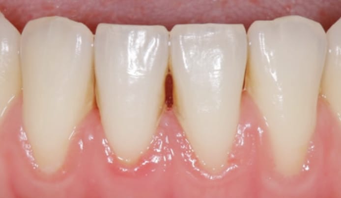 後退（下がった）歯ぐきの再生・形成・移植