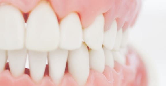 歯茎・歯肉の再生